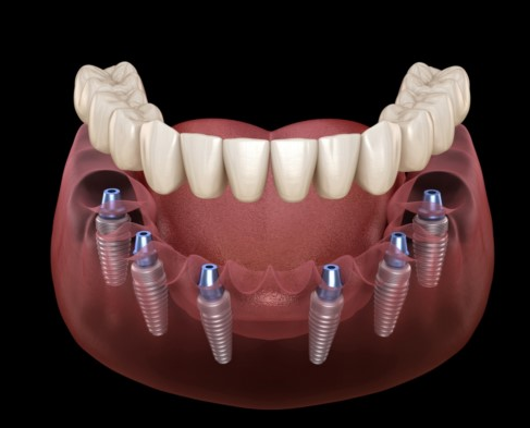 Cần phải làm gì sau khi cấy ghép Implant? | Vinmec