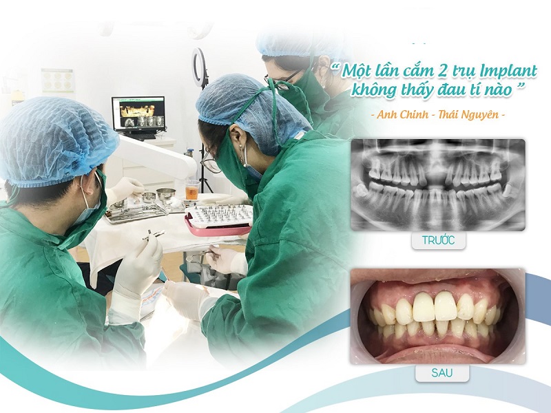 Cấy ghép Implant 7 phút không đau